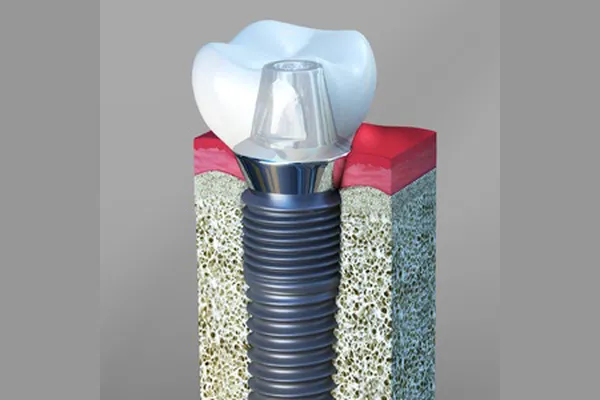 Are Dental Implants Safe Stuart