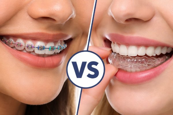 Braces or Invisalign: Which Is Preferable? | Stuart, FL