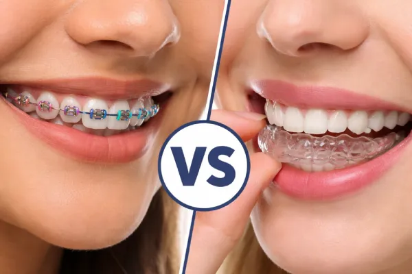 Braces or Invisalign: Which Is Preferable? | Stuart, FL