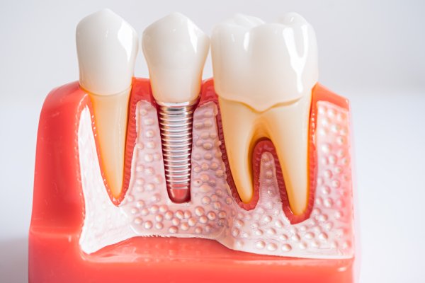Common Questions About Dental Implants in Stuart