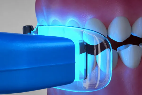 Does Teeth Whitening Affect Dental Implants? | Stuart