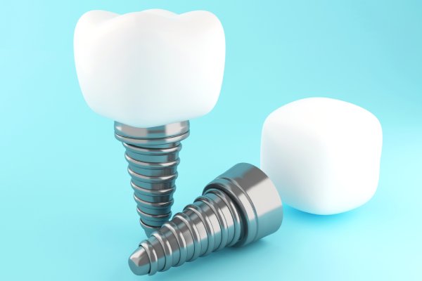 The need for dental implants
