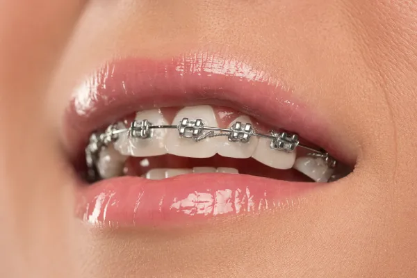 Top Benefits of Getting Dental Braces in Stuart