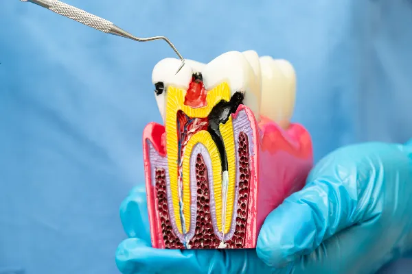 Top Benefits of Root Canal Treatment in Stuart
